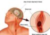 Thiền, Stroke Và Trái Tim