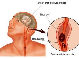 Thiền, Stroke Và Trái Tim
